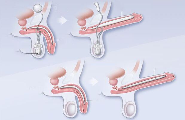 penile exam for impotence